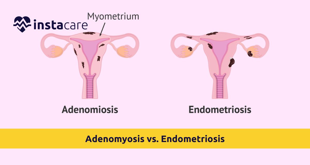 Picture of Adenomyosis vs Endometriosis - What You Should Know