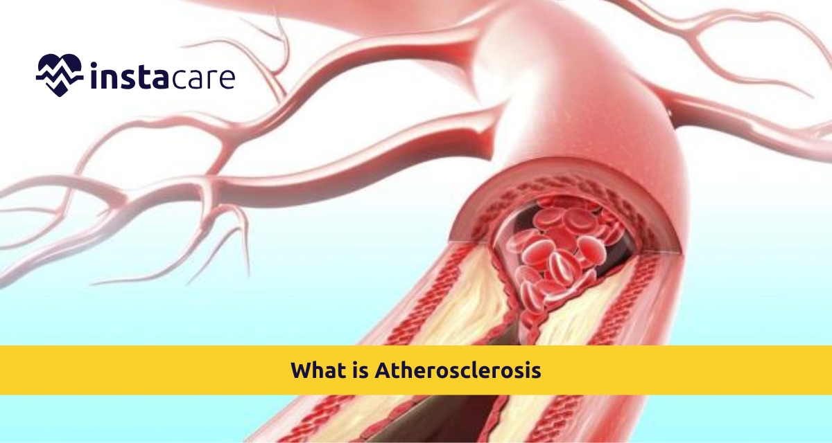 Picture of What is Atherosclerosis