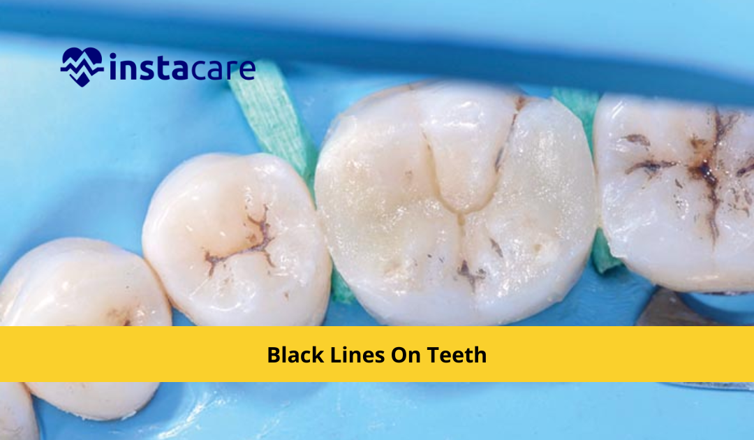 Picture of What You Must Know About Black Lines On Teeth