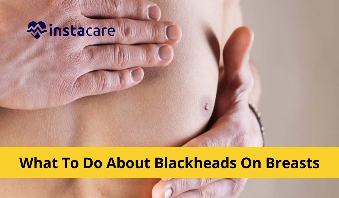 What To Do About Blackheads On Breasts?