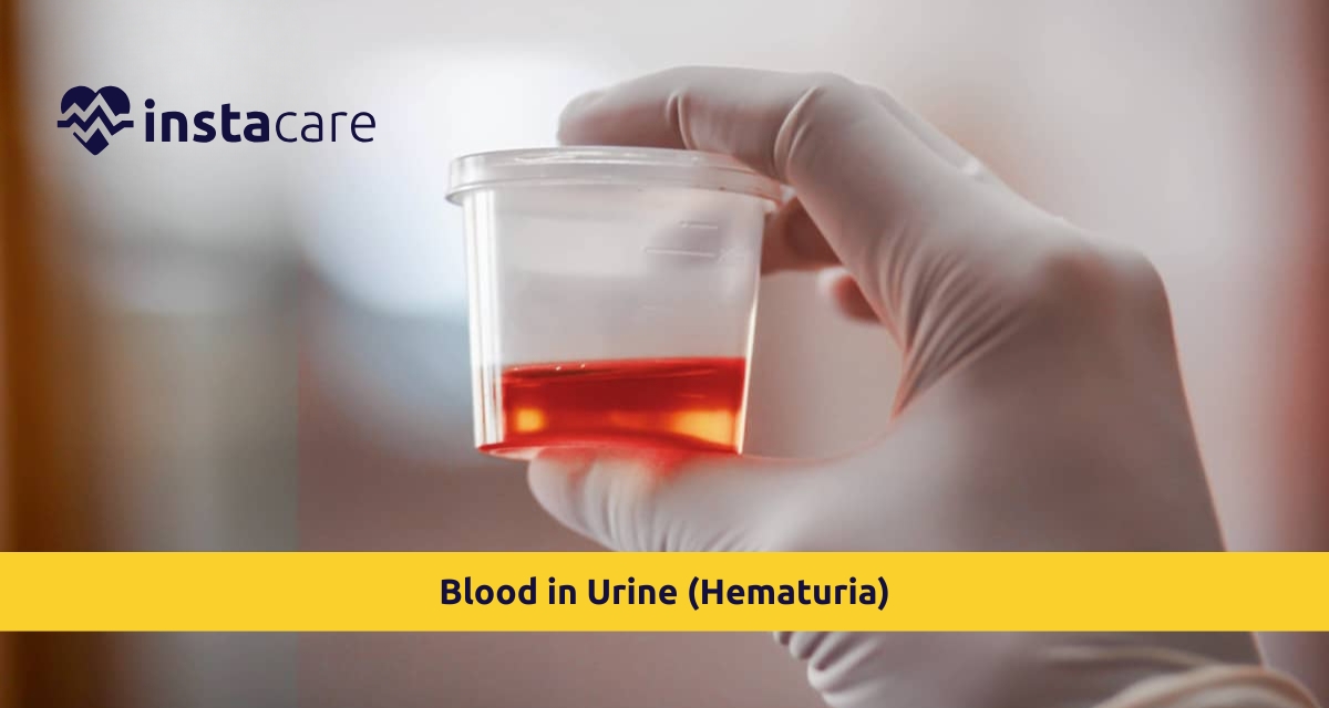 Picture of Blood in Urine Hematuria