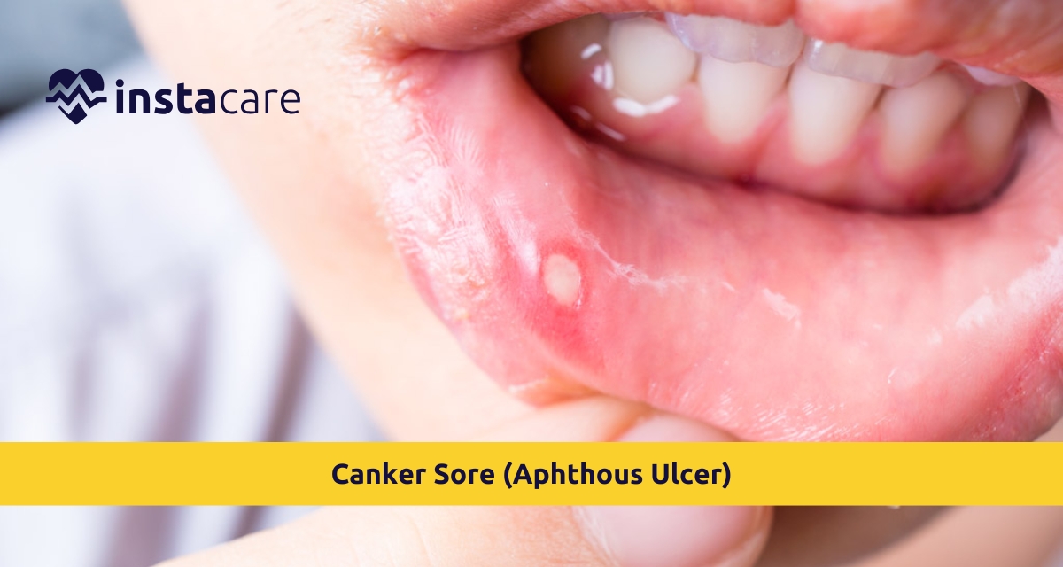 Picture of Canker Sore Aphthous Ulcer