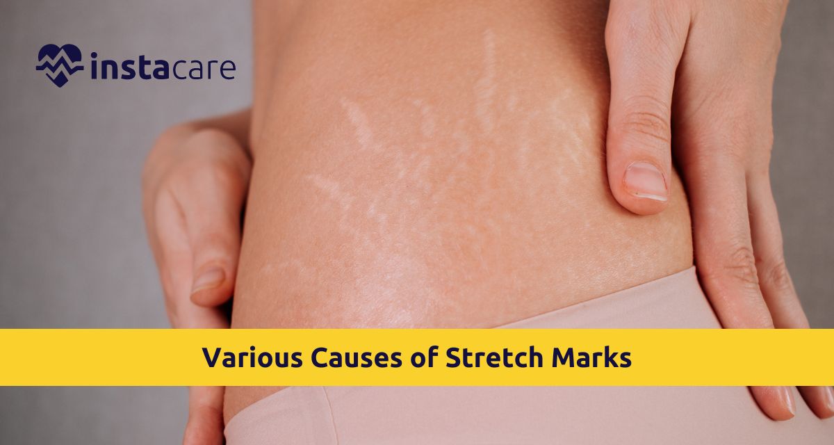 Picture of What Are Various Causes Of Stretch Marks