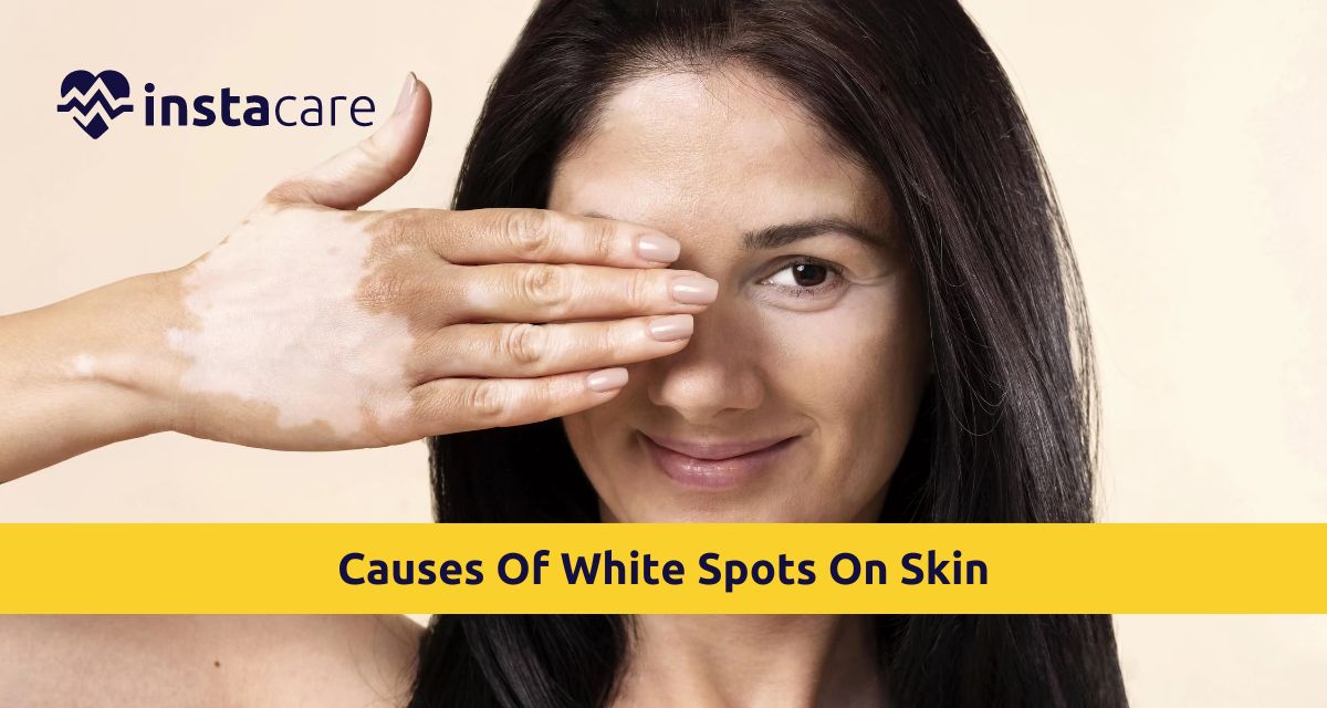 Some Important Causes Of White Spots On Skin To Be Aware Of