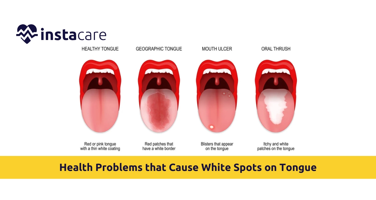 Picture of Find out What Health Problems White Spots on Tongue Can Cause