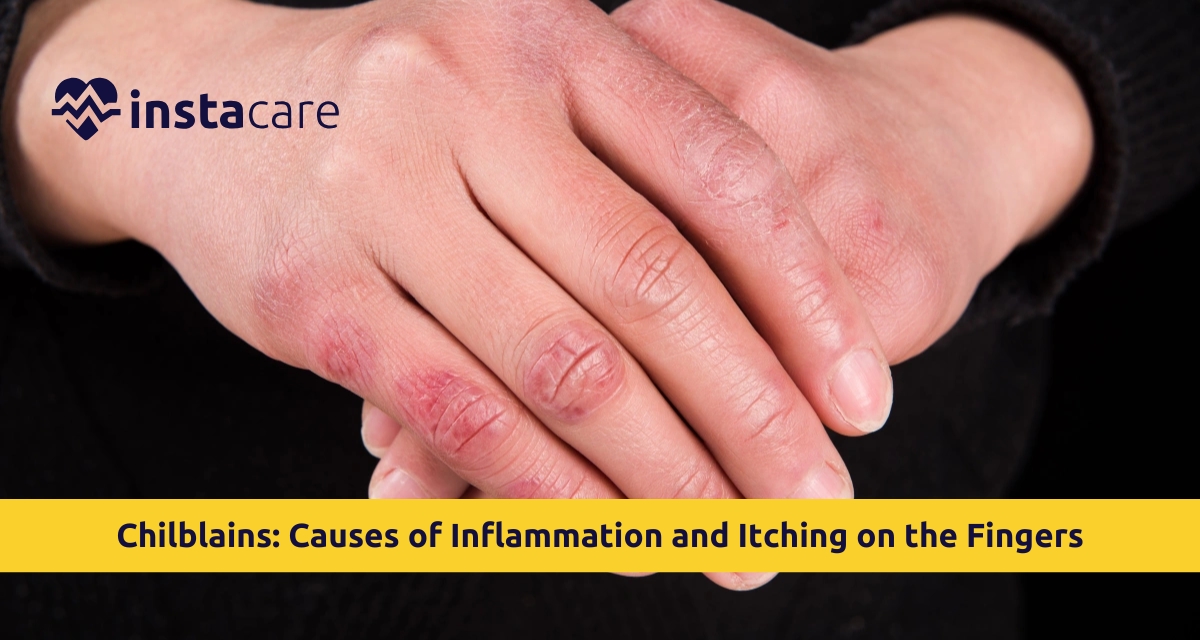 Picture of Chilblains Causes of Inflammation and Itching on the Fingers