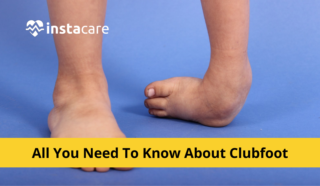 Bare Foot Baby - Everything You Need To Know About Clubfoot