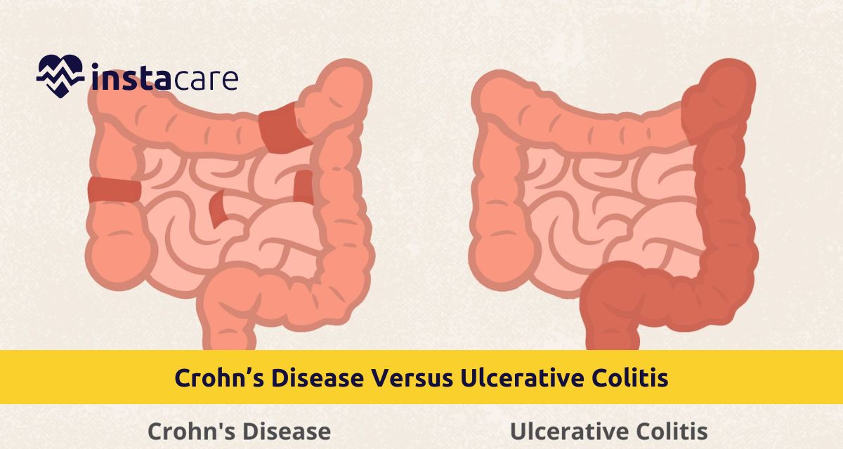 Picture of Crohns Disease Versus Ulcerative Colitis Whats the Difference