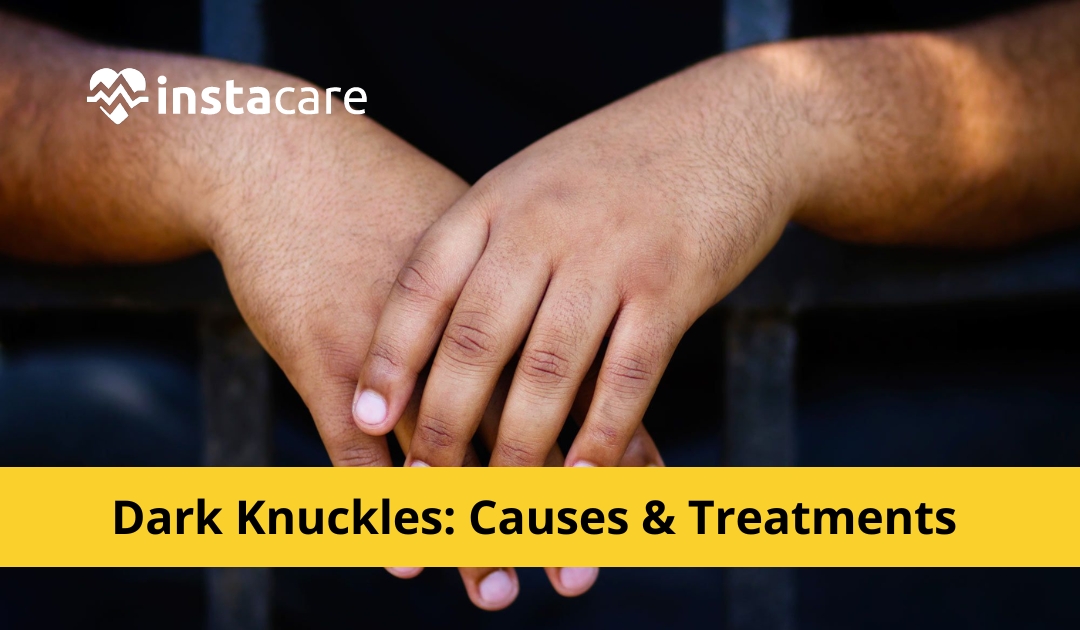 Picture of Dark Knuckles Causes Treatments and Natural Remedies