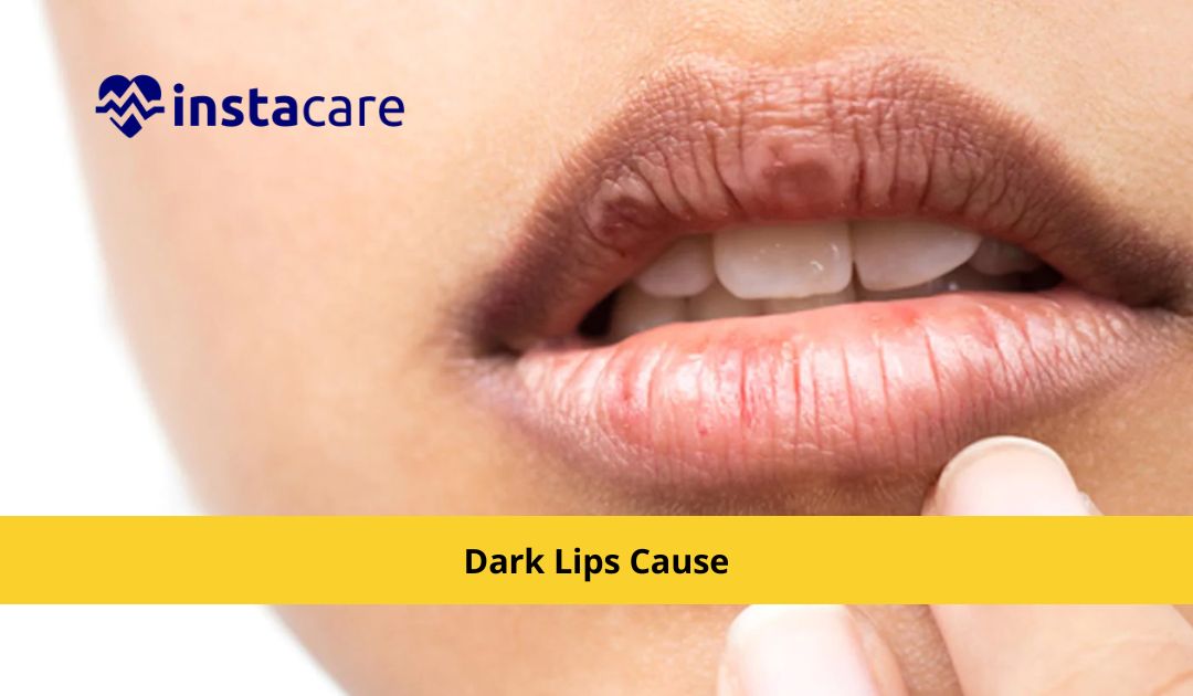 Picture of Dark Lips Cause and Natural Remedies