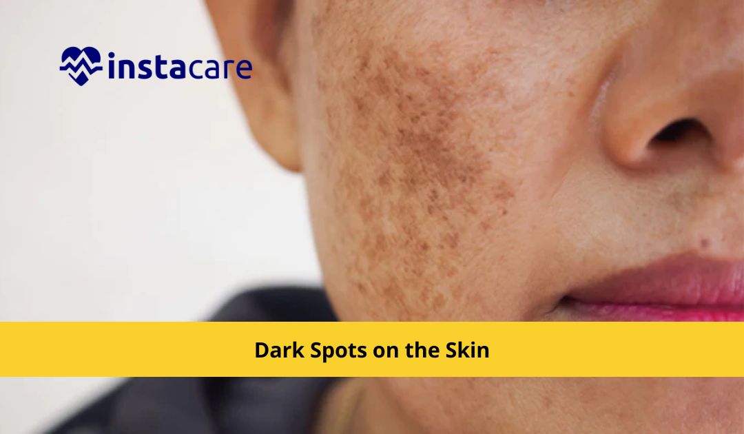 Picture of What Are The Symptoms And Treatment Of Dark Spots On The Skin