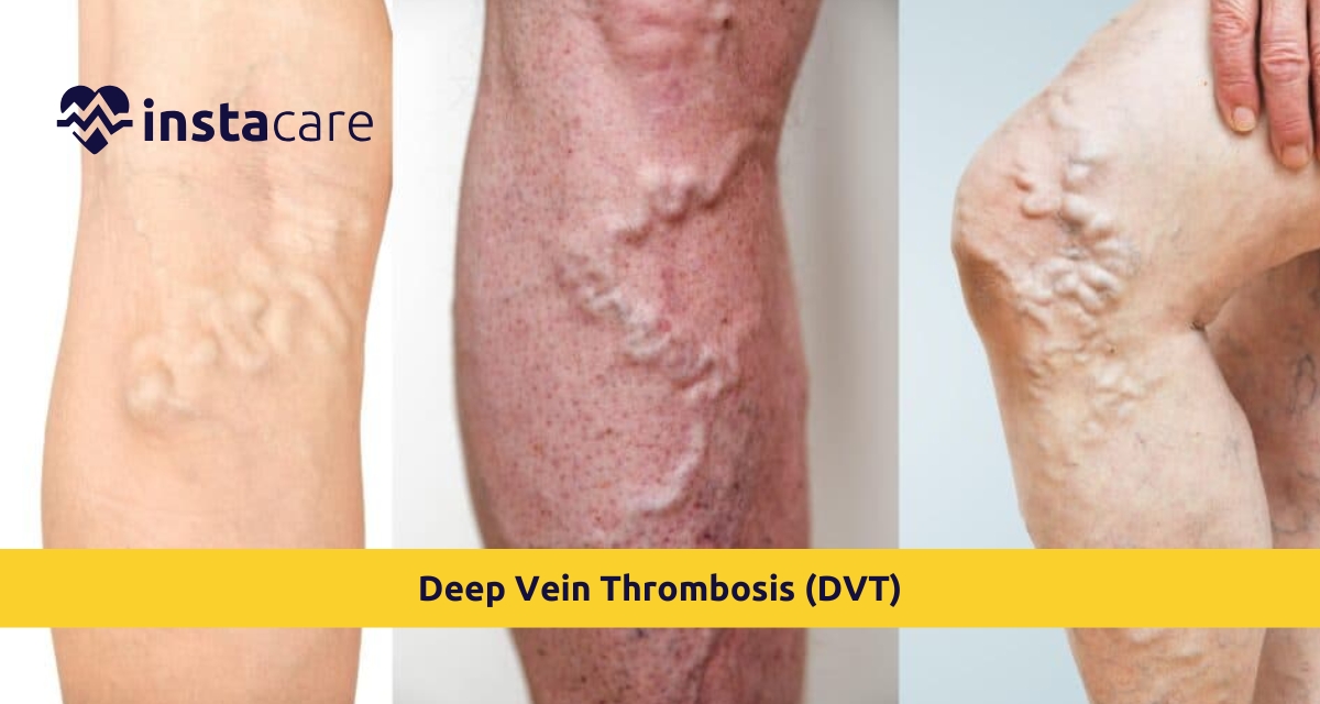 Picture of Deep Vein Thrombosis DVT