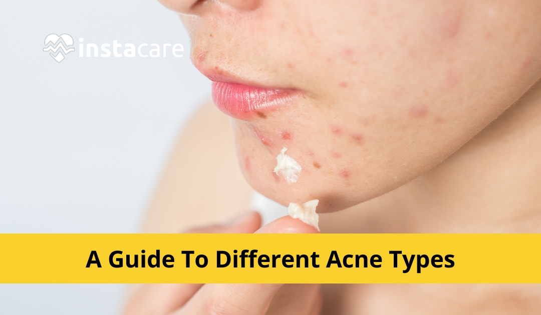 A Guide To Different Acne Types