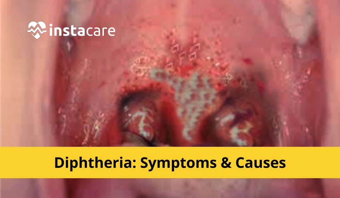 diphtheria pseudomembrane removal