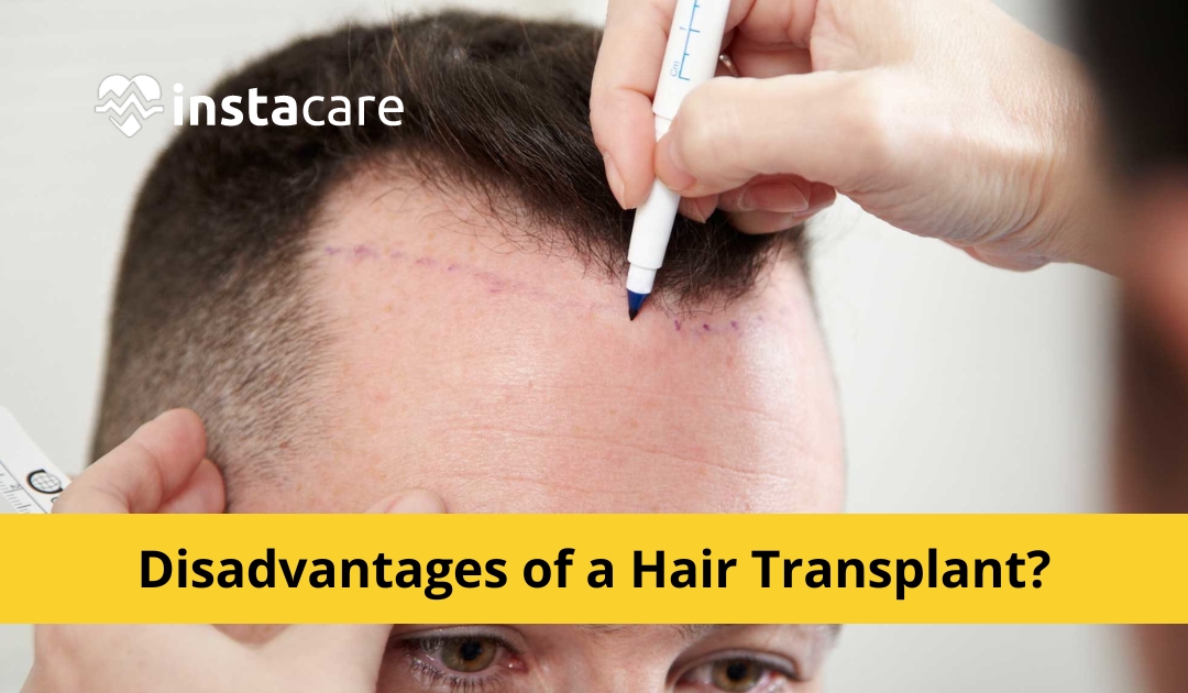 Best Hair Loss Treatment | Hair Transplant Clinic in Surat | AHS India