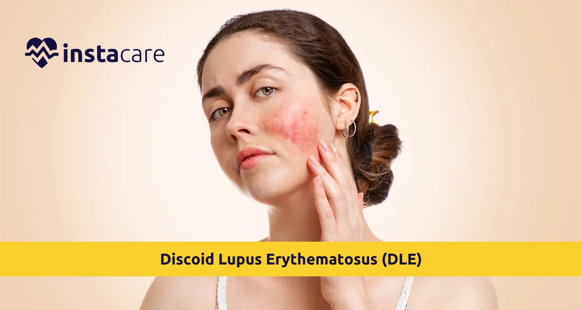 Picture of Discoid Lupus Erythematosus DLE