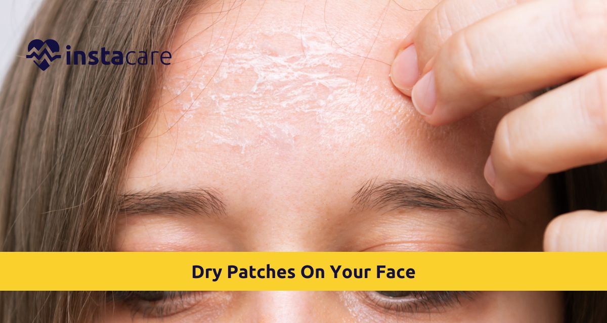 Picture of What Causes Dry Patches On Your Face