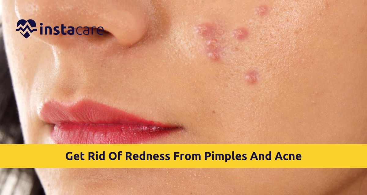 Picture of How To Get Rid Of Redness From Pimples And Acne