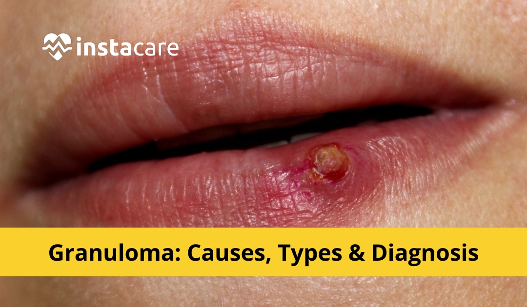 What Is Granuloma Causestypes Diagnosis And Treatment