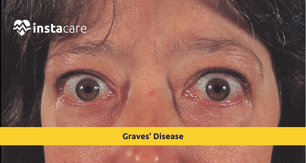 Picture of Graves Disease