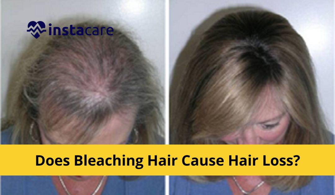 The Hair Loss Risks Of Bleaching Your Hair – What You Need To Know