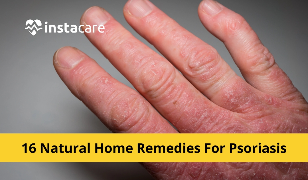Picture of 16 Natural Home Remedies For Psoriasis