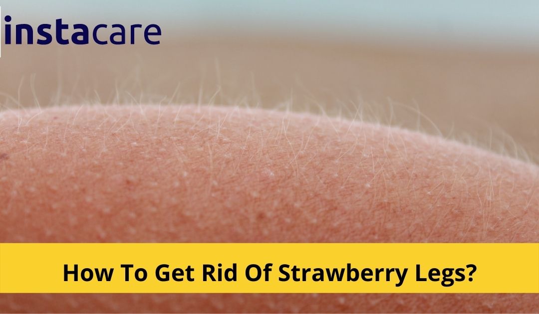 How Do You Get Rid Of Strawberry Legs? | Treatment and Prevention