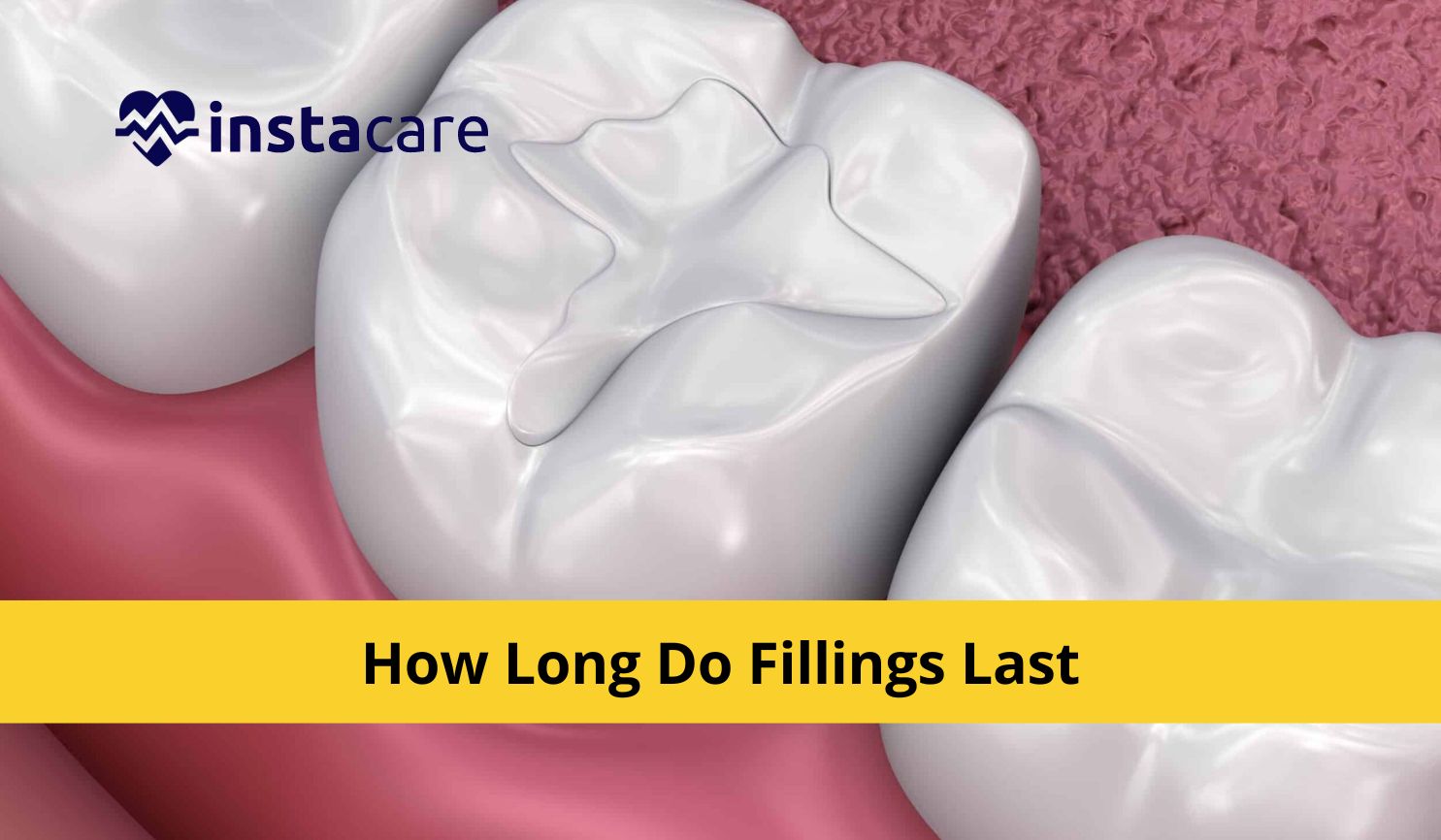 Picture of How Long Do Fillings Last