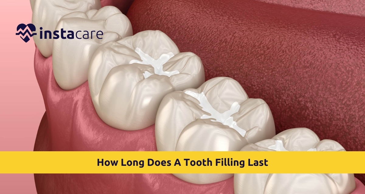 Picture of How Long Does A Tooth Filling Last