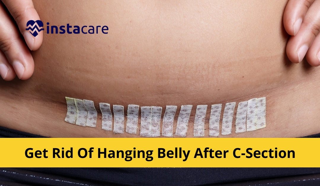 Best Tummy Reducing Belt After C-Section - Ease Backache & Promote Mobility  