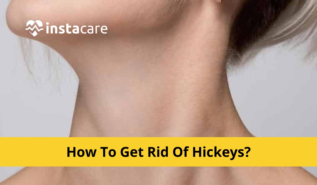 Picture of How To Get Rid Of Hickeys 8 Easy Tips That Actually Work