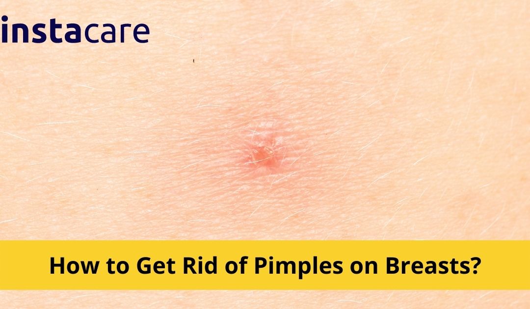 Picture of How to Get Rid of Pimples on Breasts Instacare