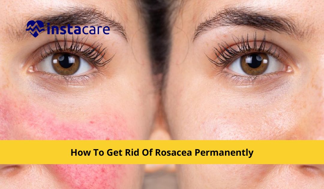 Picture of  How To Get Rid Of Rosacea Permanently