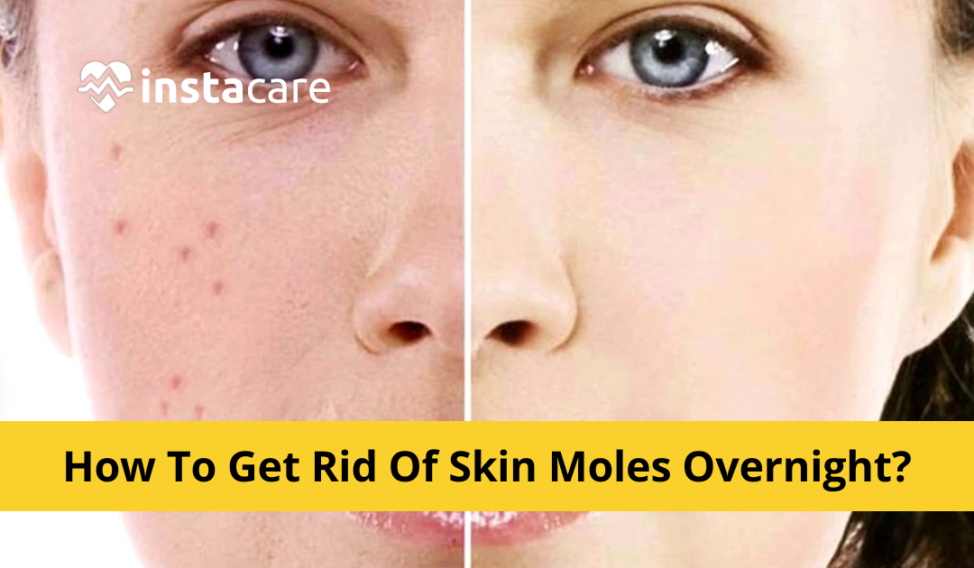  How To Get Rid Of Skin Moles Overnight 