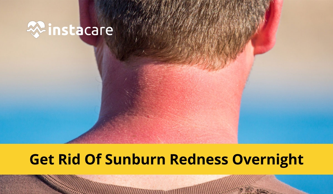 How To Get Rid Of Sunburn Redness Overnight? 5 Home Remedies