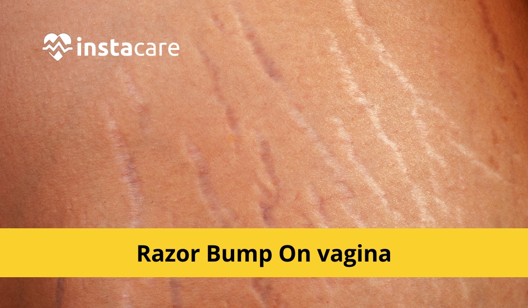 Picture of How to Quickly Get Rid of Razor Bumps on the Vagina