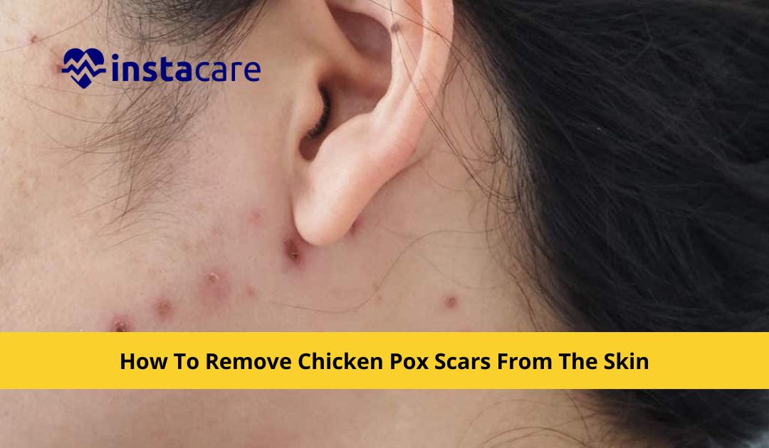 Picture of How To Remove Chicken Pox Scars From The Skin