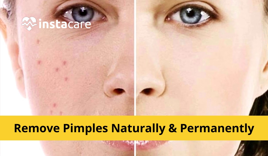 How To Remove Pimples Naturally And Permanently At Home