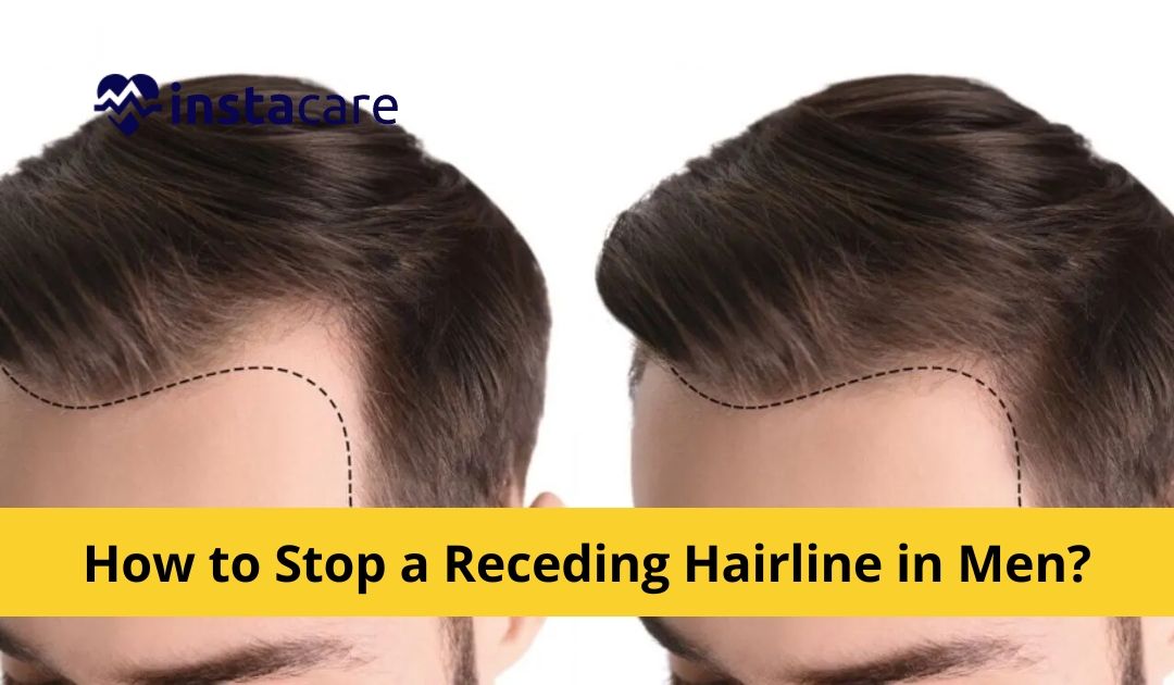 How To Stop A Receding Hairline? Causes And Treatment