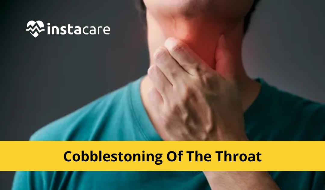 Picture of How To Identify And Treat Cobblestoning Of The Throat For Men Women