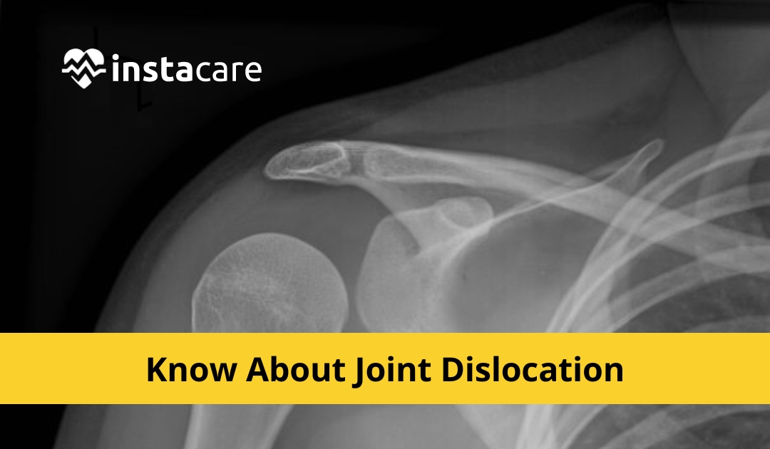 Picture of What Must You Know About Joint Dislocation