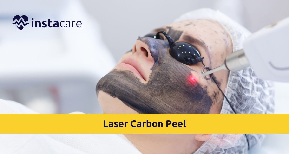 Picture of Everything You Need to Know About a Laser Carbon Peel