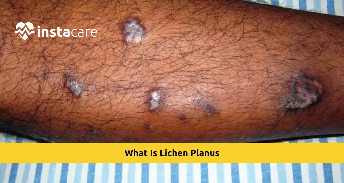 Picture of What Is Lichen Planus