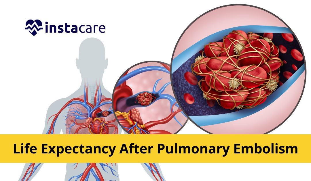 Picture of What Is Life Expectancy After Pulmonary Embolism