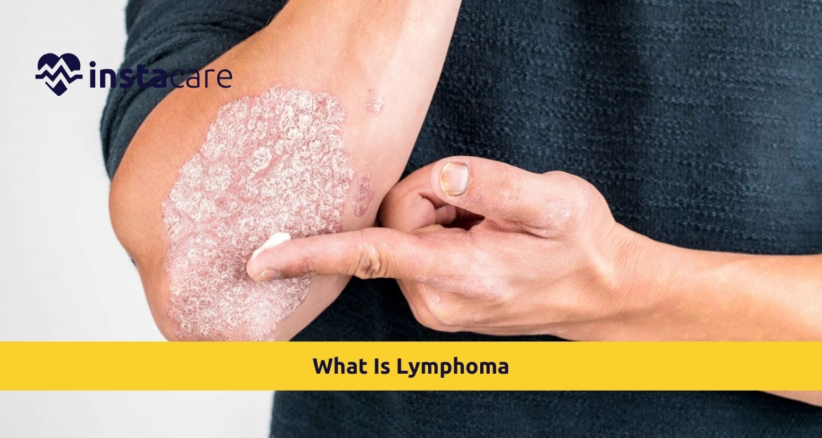 Picture of What Is Lymphoma