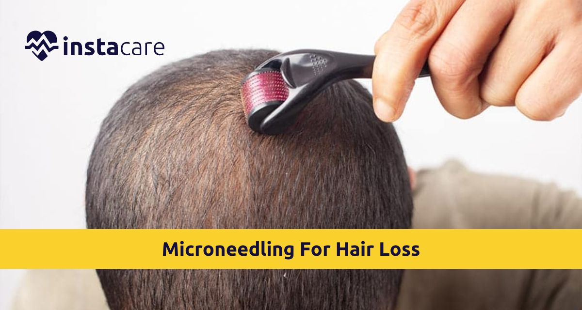 Picture of Understand All About Microneedling For Hair Loss At Home This Year