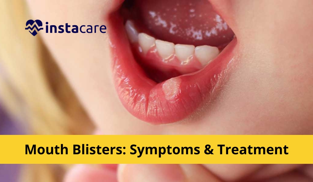 Picture of Mouth Blisters - Symptoms Treatment And Prevention Methods