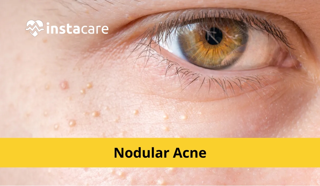 Picture of Nodular Acne Causes Symptoms Treatment and More