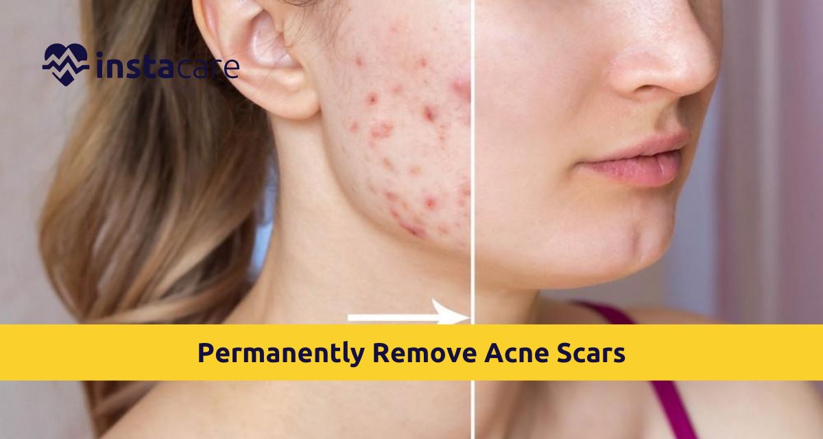 Picture of How Can You Permanently Remove Acne Scars