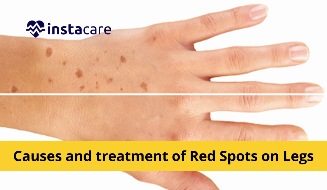 Picture of Causes And Treatment Of Red Spots On Legs